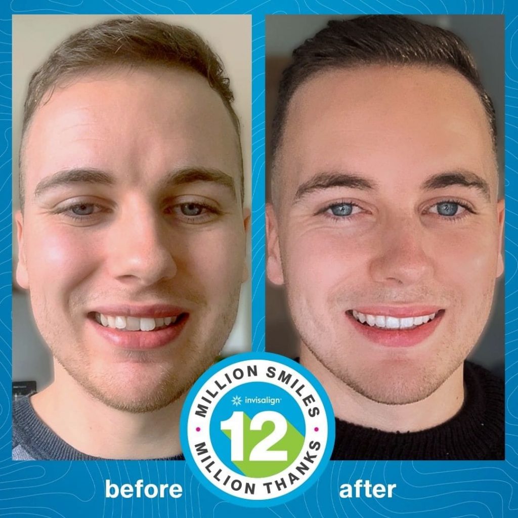 allineatori-invisibili-invisalign-studio-dentistico-frassanito
